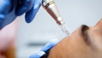 CDC detallan los primeros casos de VIH transmitido a través de “faciales de vampiro” en EEUU